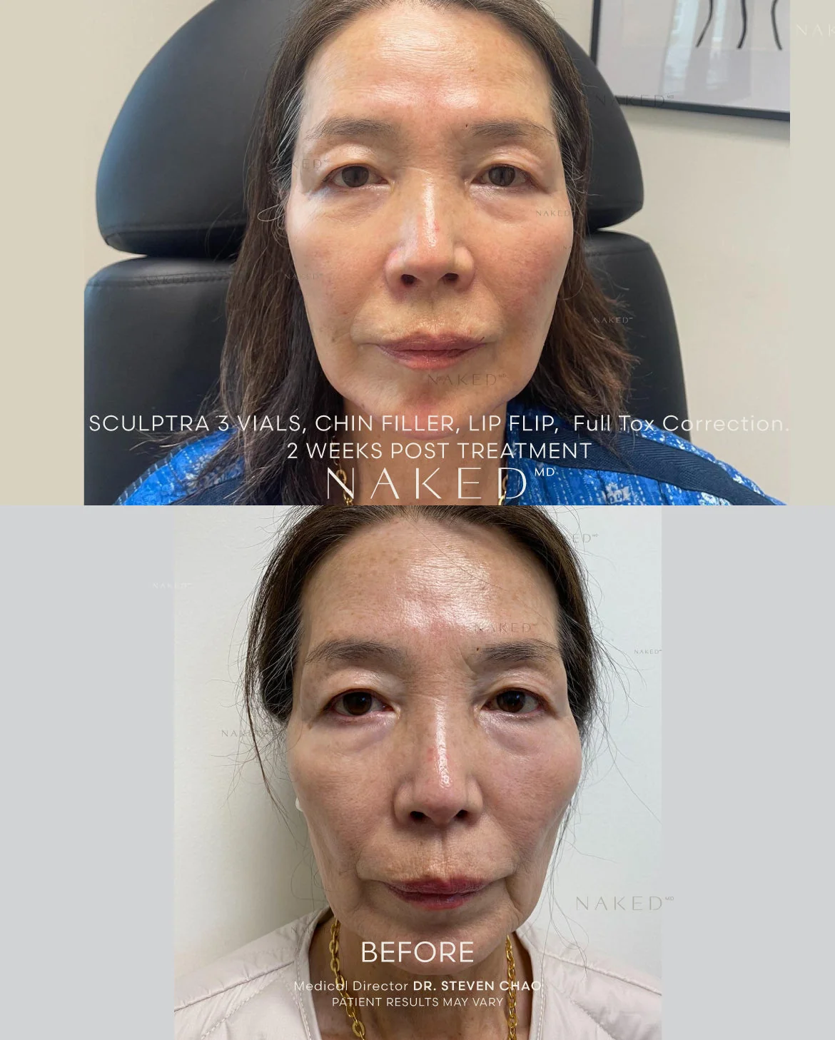 Chin Filler | New Client Offer - Image 13