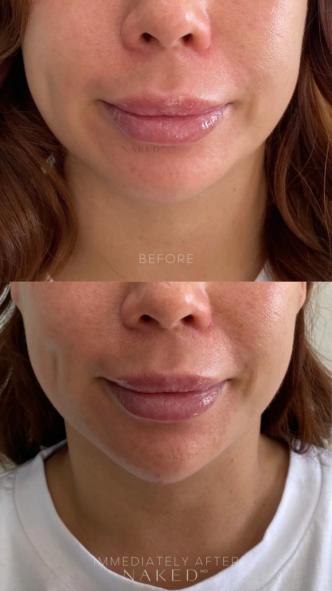 Chin Filler | New Client Offer - Image 7