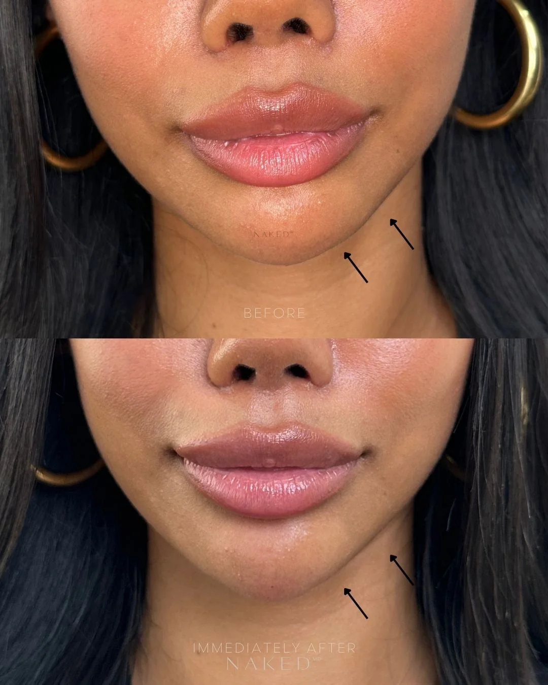 Chin Filler | New Client Offer - Image 8
