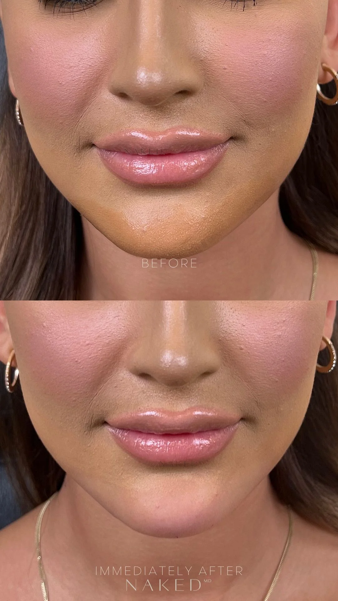 Chin Filler - Image 11