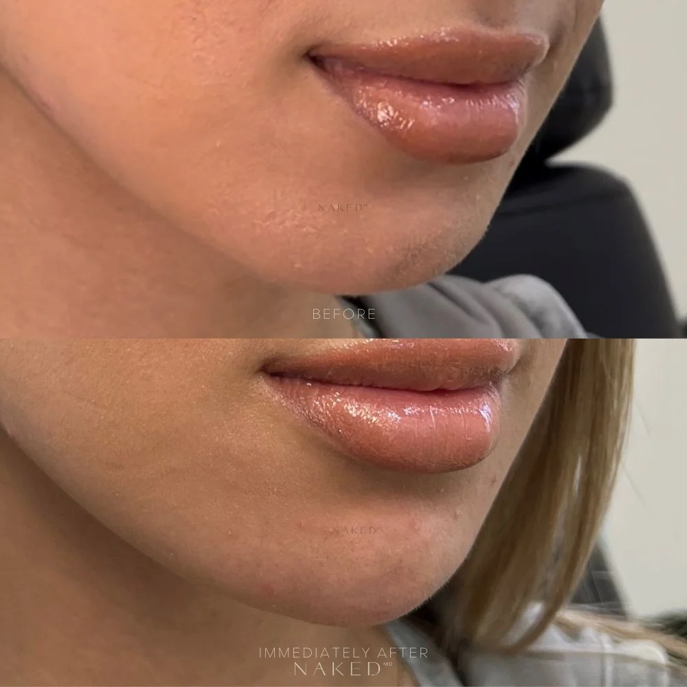 Chin Filler - Image 7