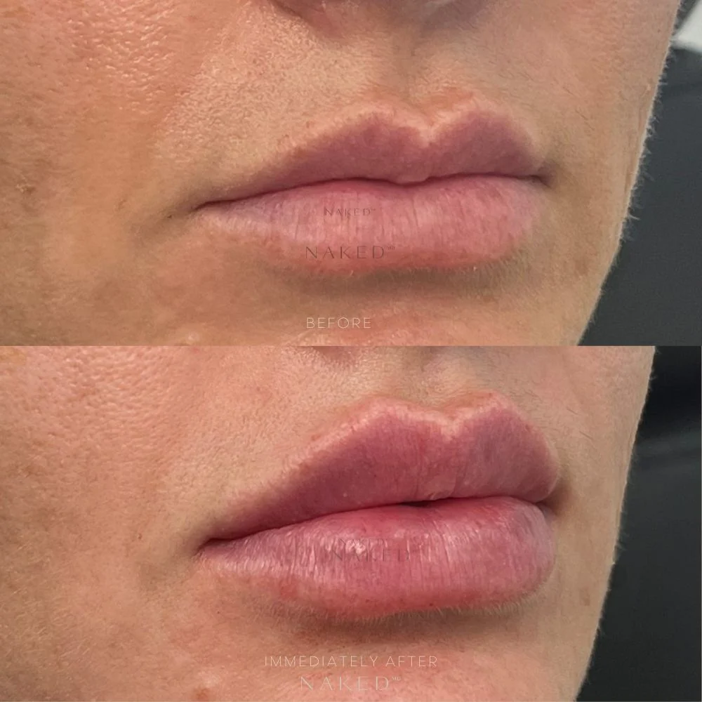 New Client | Naked Lips | Lip Filler - Image 12