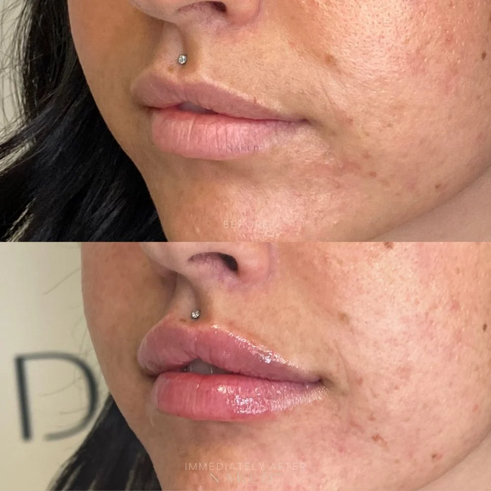 New Client | Naked Lips | Lip Filler - Image 16