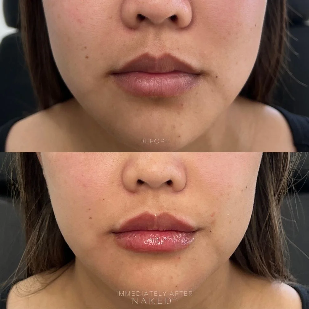 New Client | Naked Lips | Lip Filler - Image 17