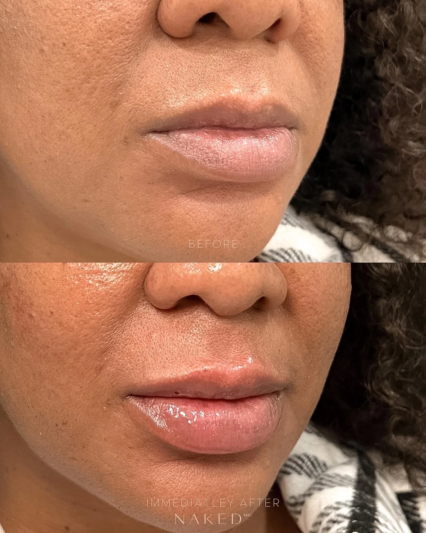 New Client | Naked Lips | Lip Filler - Image 18