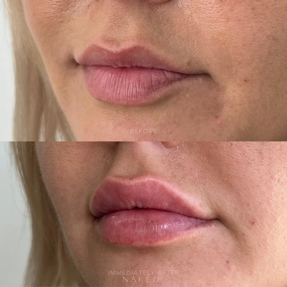 New Client | Naked Lips | Lip Filler - Image 21