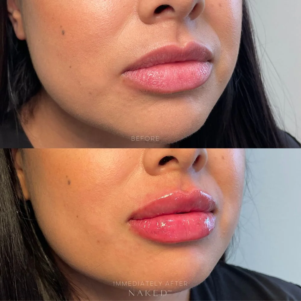 New Client | Naked Lips | Lip Filler - Image 26