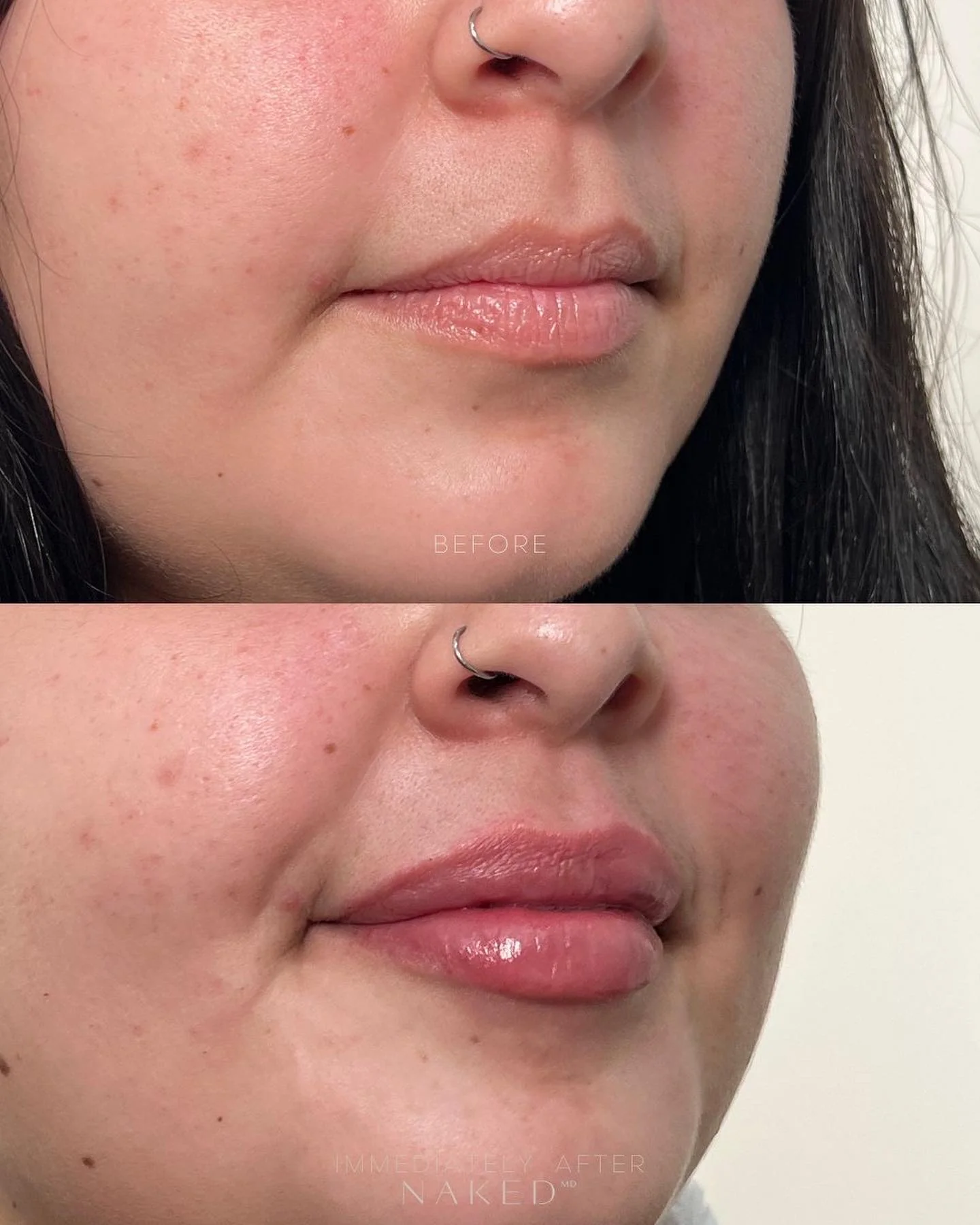 New Client | Naked Lips | Lip Filler - Image 31