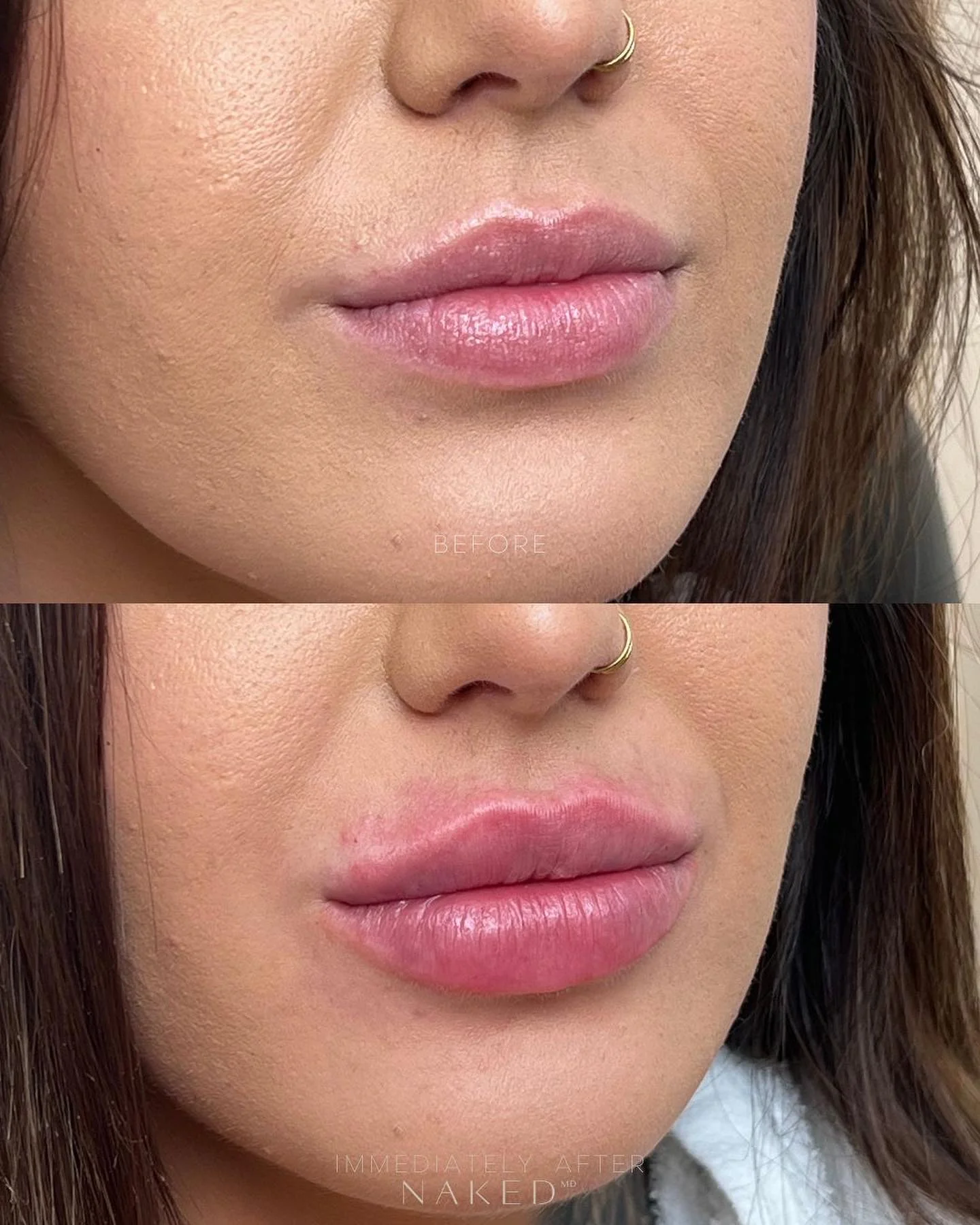 New Client | Naked Lips | Lip Filler - Image 32