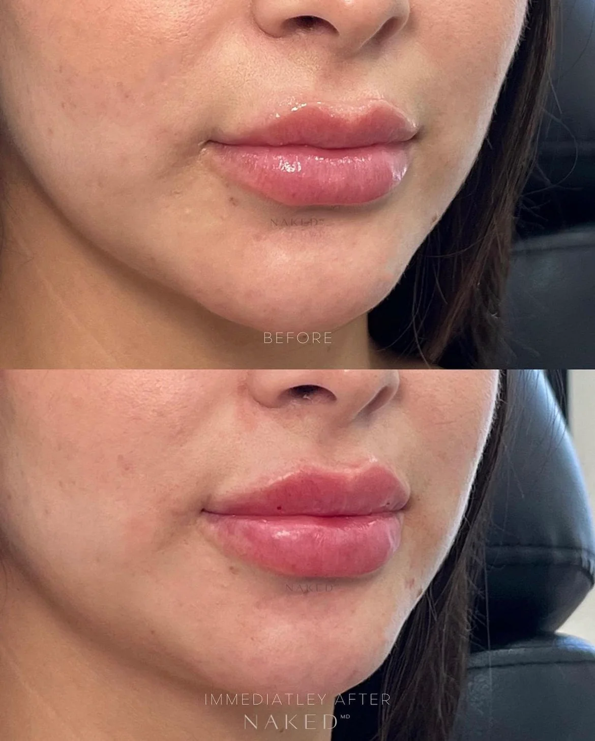New Client | Naked Lips | Lip Filler - Image 36