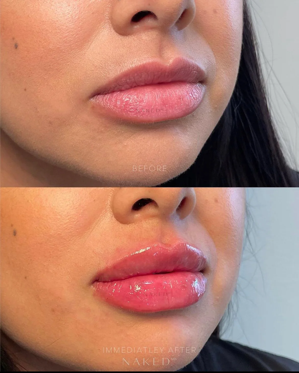 New Client | Naked Lips | Lip Filler - Image 38