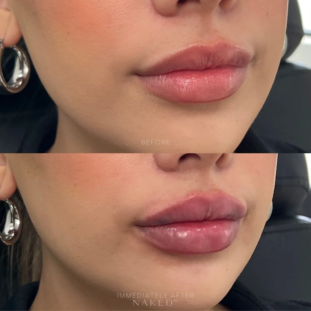 New Client | Naked Lips | Lip Filler - Image 39