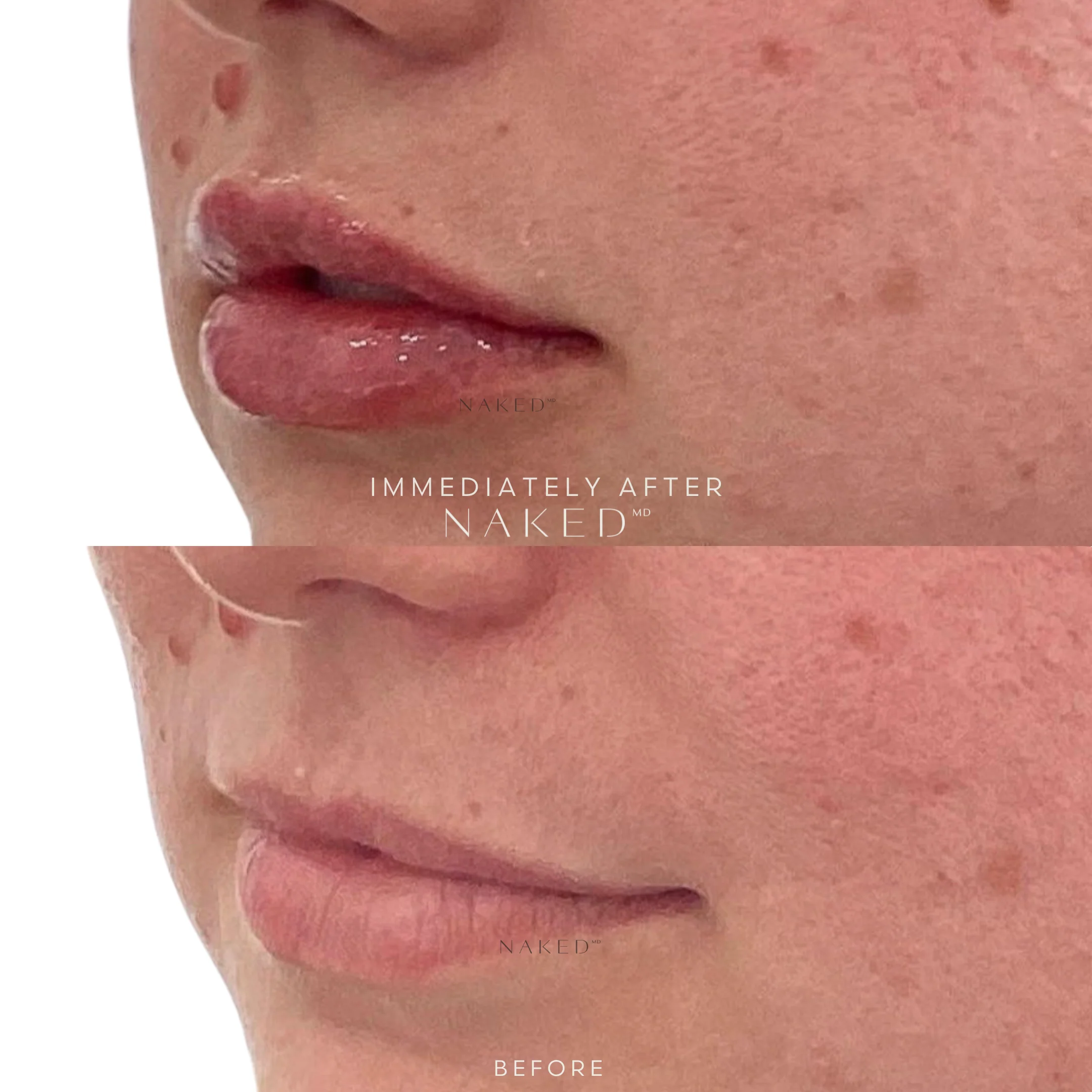 New Client | Naked Lips | Lip Filler - Image 41