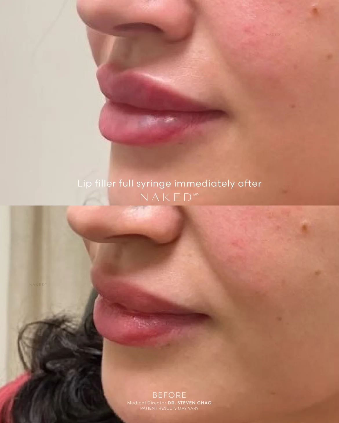 New Client | Naked Lips | Lip Filler - Image 61
