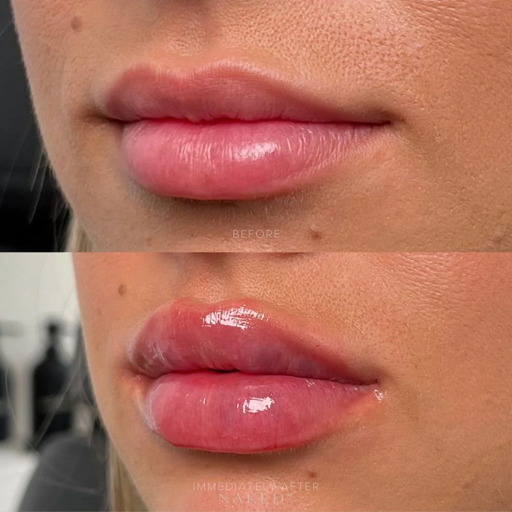 Lip Filler | New Client Offer - Image 3