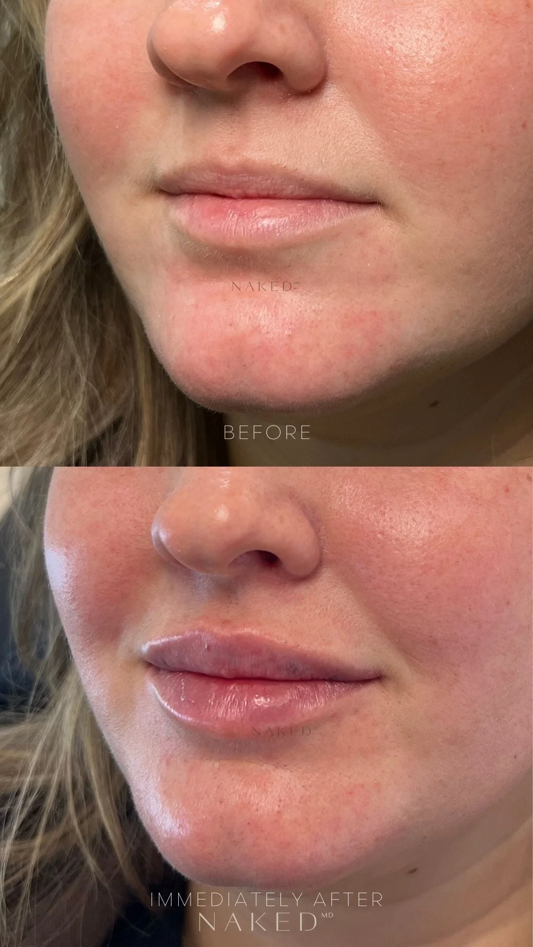 Lip Filler | New Client Offer - Image 36