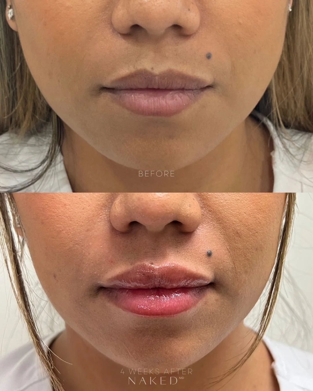 Lip Filler | New Client Offer - Image 41