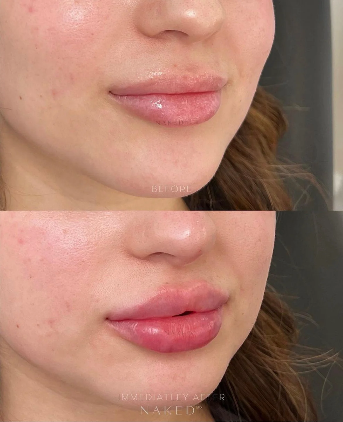 Lip Filler | New Client Offer - Image 47