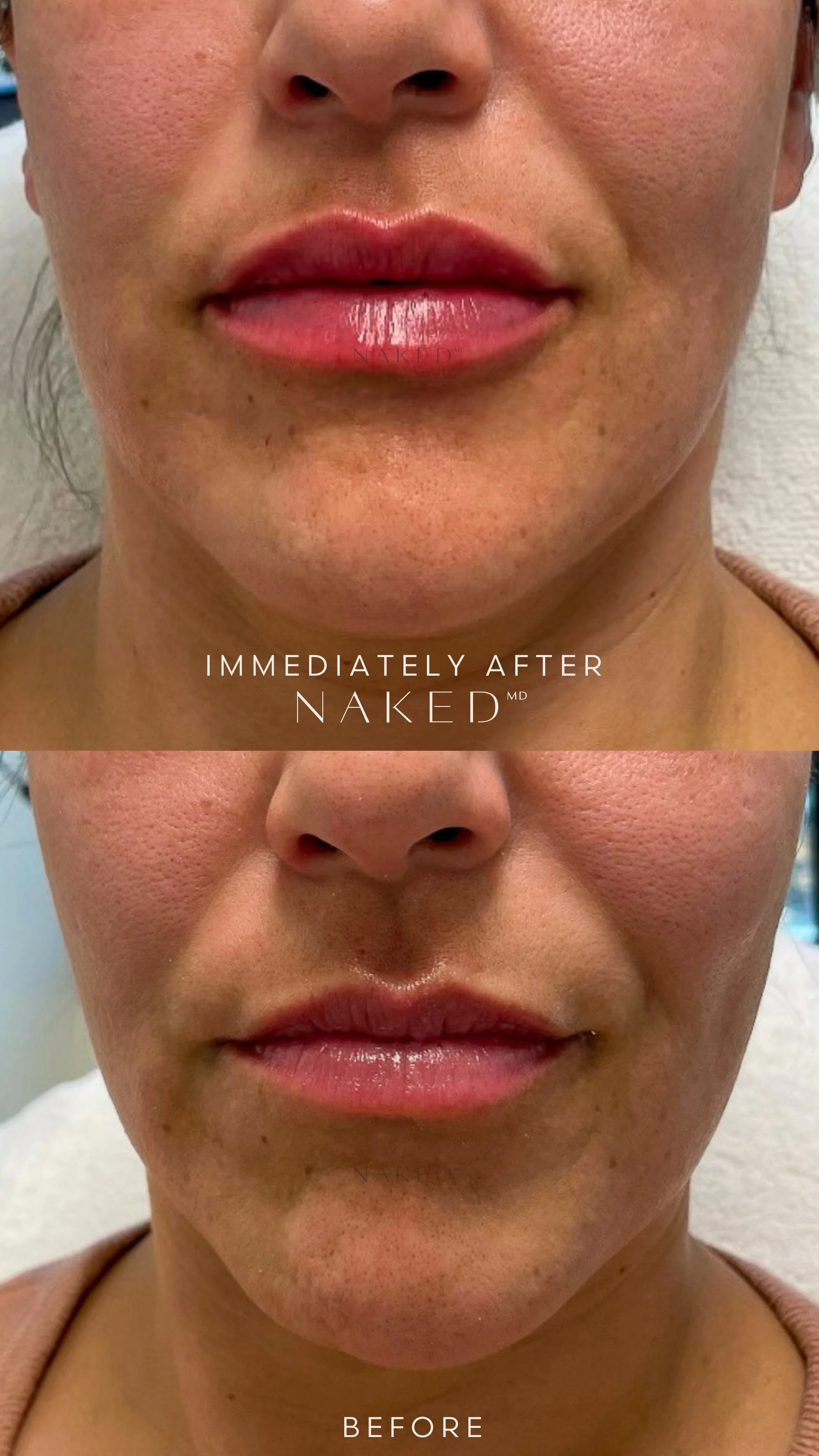 Lip Filler | New Client Offer - Image 51