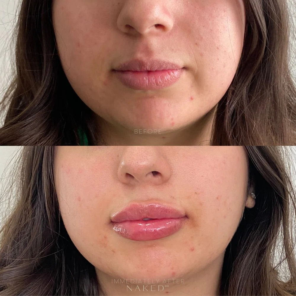 Lip Filler | New Client Offer - Image 9