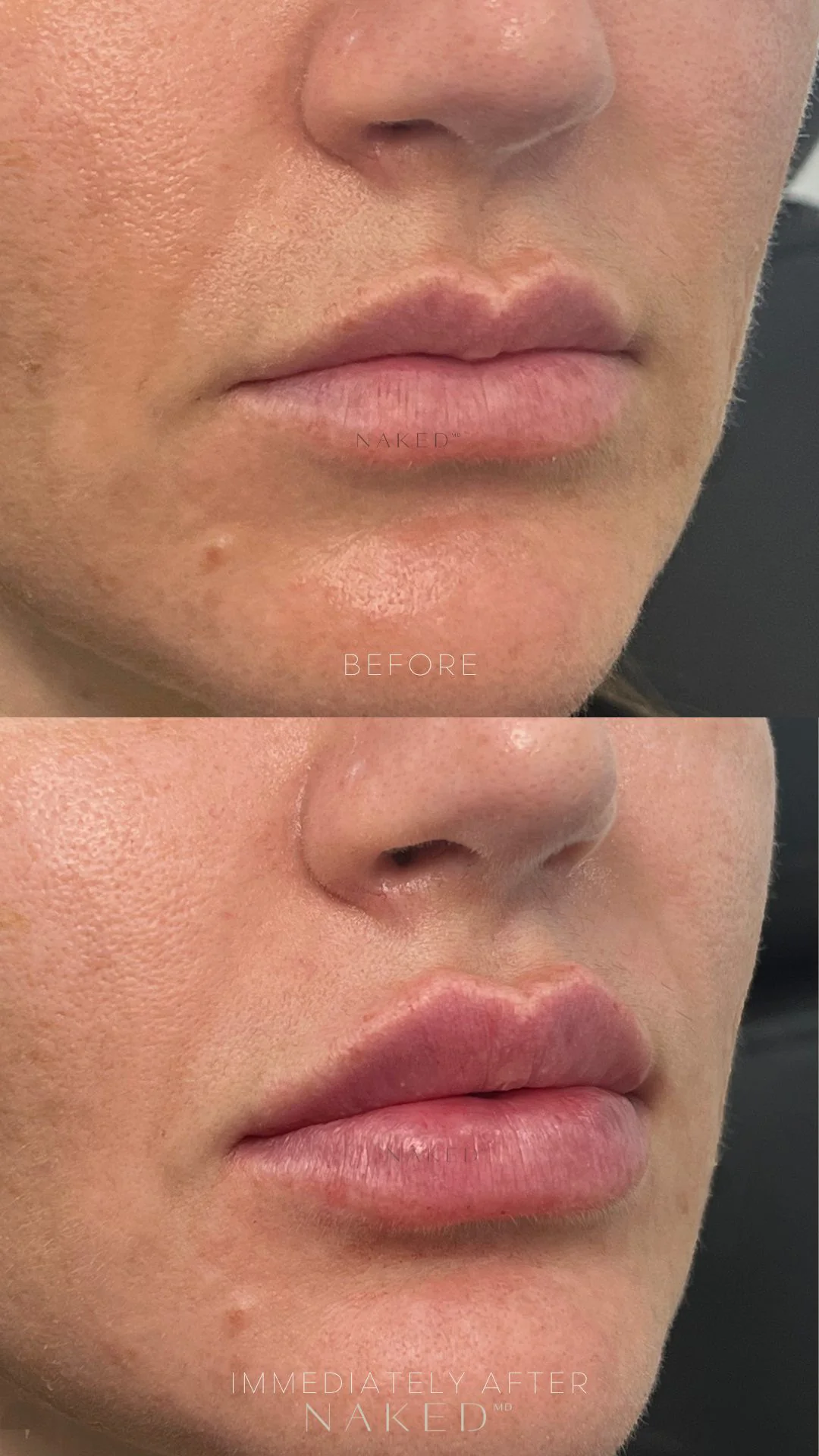 New Client | Naked Lips | Lip Filler - Image 25