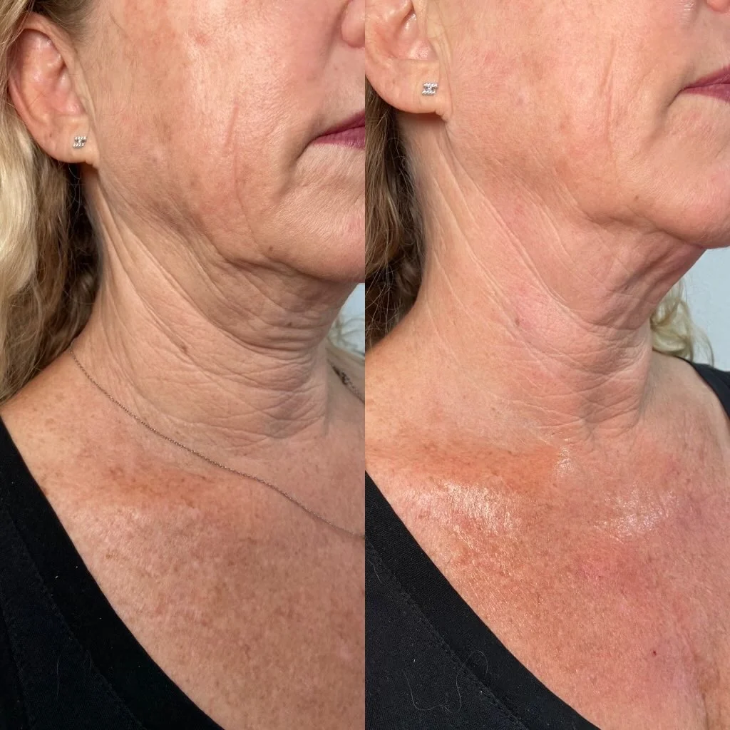 Renew Neck - Image 4