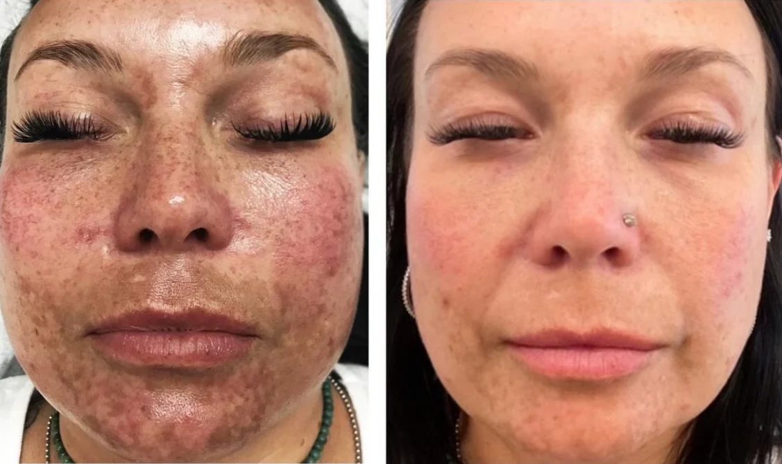 The SaltFacial® - Image 7