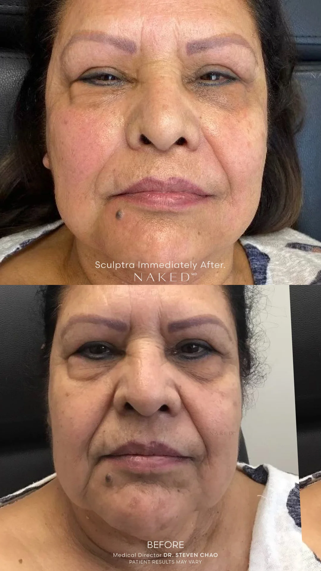 Sculptra® Filler - Image 12