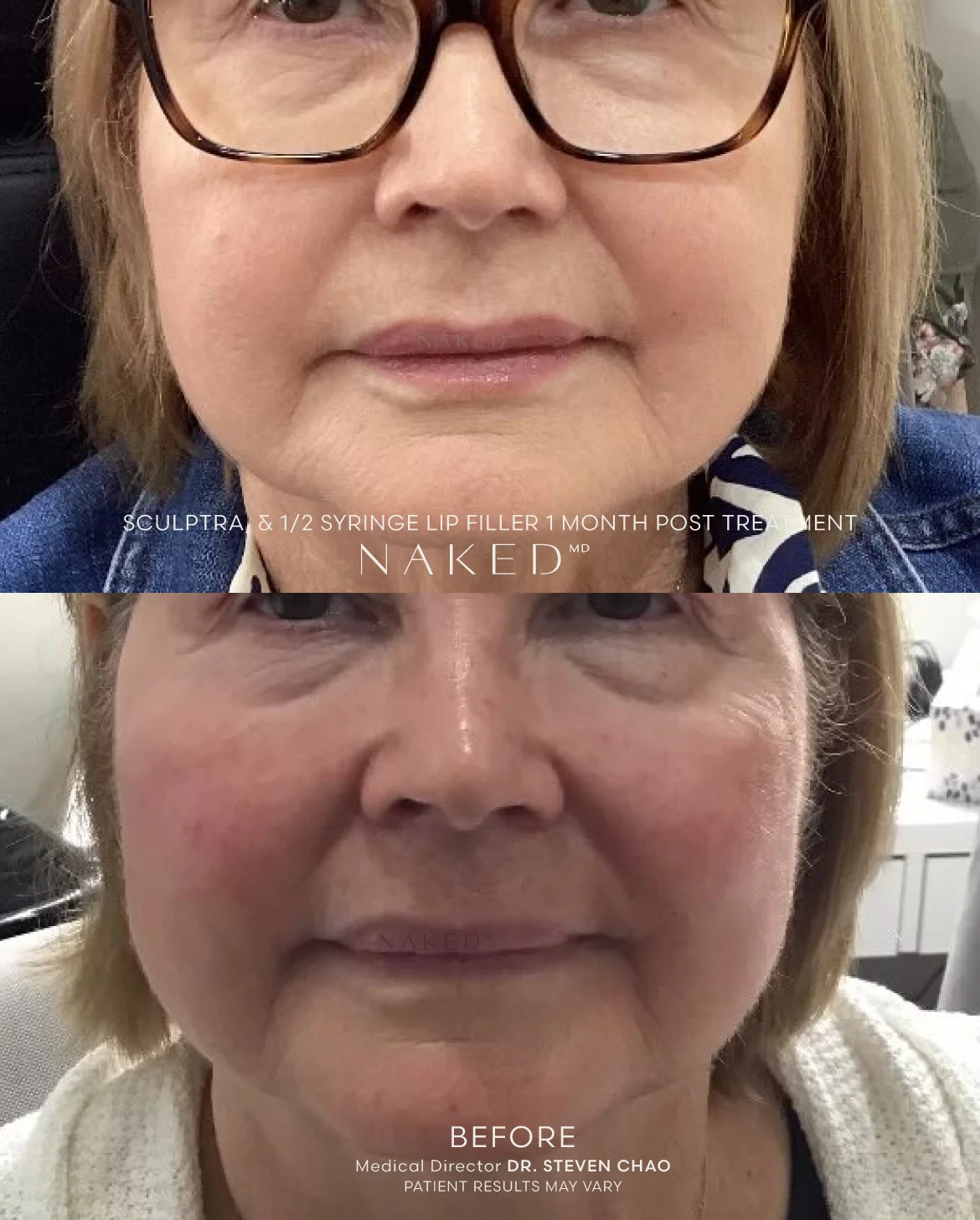 Sculptra® Filler - Image 7
