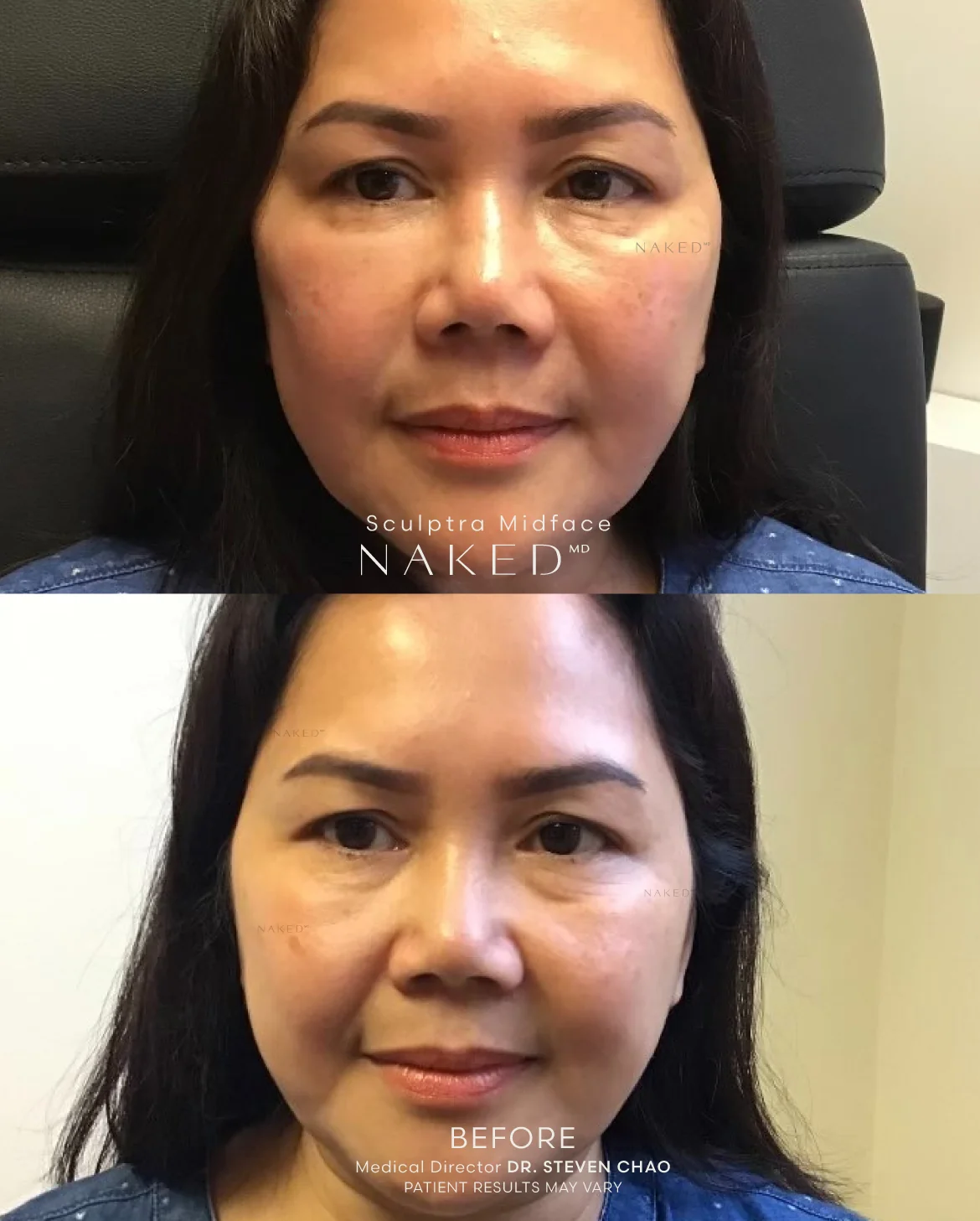 Sculptra® Filler - Image 9
