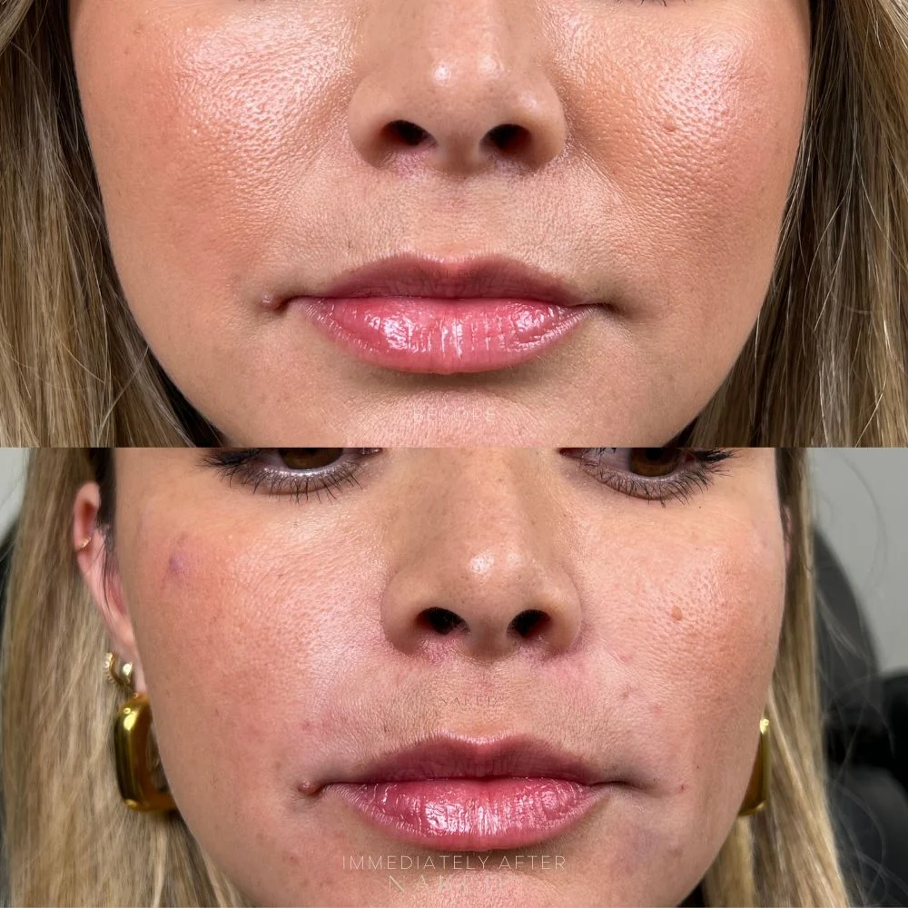 Smile Lines Filler - Image 5