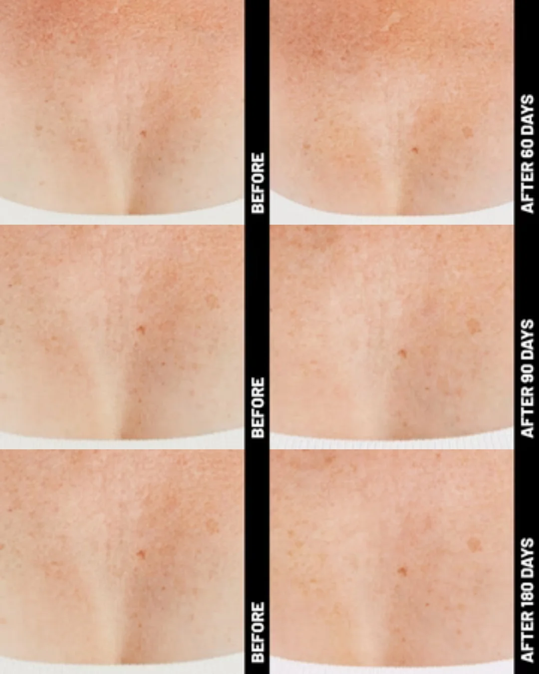 Ultherapy® | Non-Surgical Ultrasound Therapy - Image 14